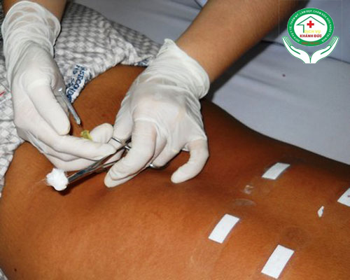 Dịch vụ Cấy chỉ tại nhà